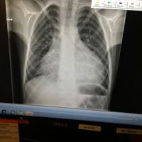 X-ray of Alex's Heart